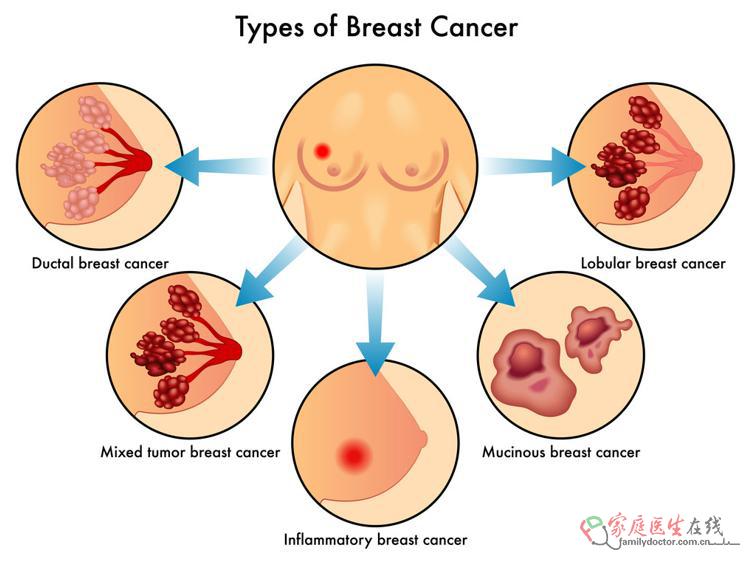 乳腺增生常见不都癌变女性莫慌