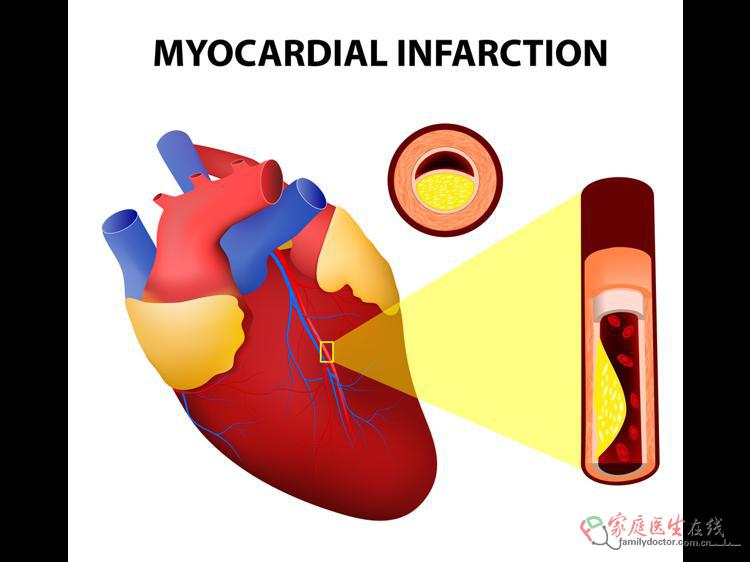 心梗来临有预警早知能救命
