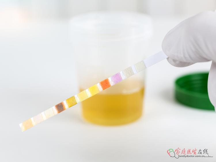 晨尿变浓茶色？四类原因早识别，避免健康危机！